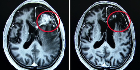Hirntumor wurde mit Krebspillen+Methadon
                    geheilt