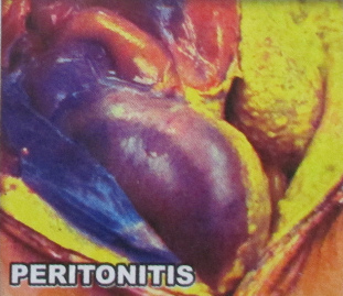 Enfermedad
                        del aparato digestivo: peritonitis