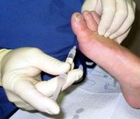 Die "Schulmedizin"
                            gibt dann bis heute eine Spritze in den Fuss
                            gegen die Schmerzen der
                            "Operation"