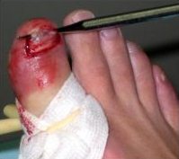 Die "Schulmedizin"
                            l�st die Fussn�gel gewaltsam ab