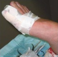 Die Operation der
                            "Schulmedizin" ist nicht nur sehr
                            kostspielig, sondern verursacht auch eine
                            lange Rekonvaleszenzzeit mit vielen
                            Verbandswechseln und langem Arbeitsausfall.