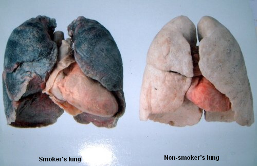 Smoker's lung in black - non-smoker's lung in
              white