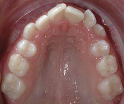 Engstand bei einem Unterkiefer, eine
                              Sicht von oben