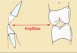 Beim sogenannten
                                "Kopfbiss" beissen Kanten der
                                Schneidez�hne und die H�cker der
                                Backenz�hne und Mahlz�hne aufeinander
                                und schleifen sich gegenseitig ab
