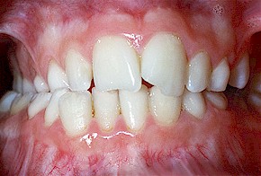 Beim sogenannten
                              "Kreuzbiss" stehen beim
                              "seitlichen Kreuzbiss"die
                              unteren Backenz�hne und Mahlz�hne mehr
                              nach aussen als die oberen: Die zur Wange
                              gerichteten H�cker ("bukkale
                              H�cker") der unteren Backenz�hne und
                              Mahlz�hne stehen frei.