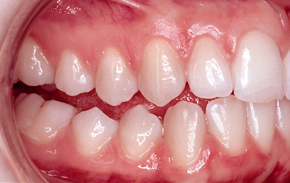 Beim seitlichen, offenen Biss kommen
                              die oberen Backen- und Mahlz�hne nicht an
                              die unteren heran