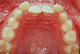 Zahnfehlstellung mit
                      gekippten, vorderen Schneidez�hnen