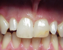 Zapfenz�hne sind Z�hne, die
                                genetisch bedingt eine reduzierte
                                Zahnkrone haben, also stumpfartig
                                aussehen, wie hier die zweiten
                                Schneidez�hne