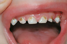 Caries de biber�n con dientes de leche
                            infectados de caries. Los tontos padres
                            da�an sus ni�os con jugos azucarados y con
                            chupetes de miel eventualmente para toda la
                            vida cuando los dientes de leche tienen que
                            ser eliminados y los dientes vecinos se
                            mueven. Los padres los m�s tontos pues
                            hechan la culpa al ni�o que fue con mucha
                            caries y el dentista cost� mucho m�s...