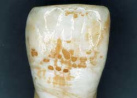 Diente con fluorosis por una masiva
                          sobredosificaci�n de fl�or