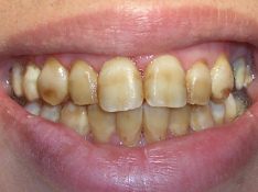 Aqu� todos los dientes son afectados por
                          fluorosis, por una masiva sobredosificaci�n de
                          fl�or
