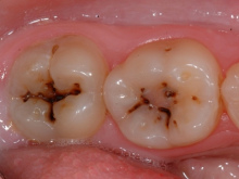 As� siempre inicia la caries: En los
                          hoyitos ("fisuras") de los dientes
                          molares se quedan restos alimentarios o se
                          queda sarro, y la caries tiene la forma como
                          la de una cruz (caries del hoyito, caries
                          fisural) [16].