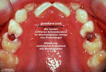 En
                          esa foto se ve muchas manchas blancas, el
                          precursor de la caries, y adem�s muchos
                          dientes son atacados por la caries de manera
                          que partes de dientes ya faltan. Parece que
                          fue f�cil para la caries aqu� porque la
                          persona apenas limpi� sus dientes y porque la
                          industria vende productos que contienen mucho
                          az�car y �cido c�trico u otros �cidos
                          (limonadas, pastel de pera, bebidas con az�car
                          y pi�a etc.) [14].