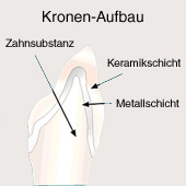 Corona
                        para el diente incisivo, la construcci�n
                        (esquema) [28]