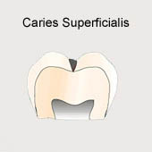 Caries superficialis [4], resp. caries
                          fisural (caries del surco) [12], esquema. El
                          tratamiento (mandrilar el lugar de caries,
                          quitar la caries a m�quina) va ser sin dolor
                          [4]
