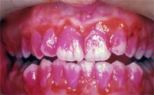 Placa
                        "colorada", con una tableta de color
                        [15]