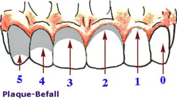 Sarro (placa bacteriana), esquema: Los
                          dentistas seccionan la placa bacteriana en
                          diversos grados, depende de la infestaci�n del
                          diente entre 0 (no.0) y 2/3 placa (no.5)
                          [15].