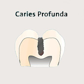 Caries profunda, esquema, la caries
                              (caries del surco) est� cerca de la pulpa
                              que se encuentra en la cueva de la pulpa
                              (generalmente llamada como
                              "nervio"). El tratamiento
                              (mandrilar el lugar de caries, quitar la
                              caries a m�quina) va ser doloroso.
                              Eventualmente la pulpa ("nervio) ya
                              es infectada con caries [4]