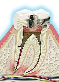 Caries de la ra�z
                        del diente (imagen) con nervio inflamado y
                        formaci�n de gases debajo de la ra�z del diente
                        [41]
