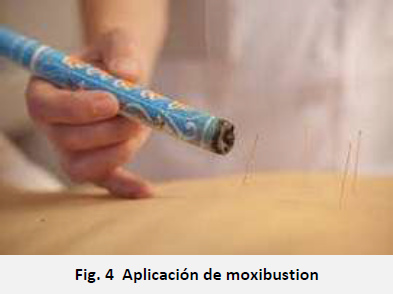 Moxibustión Moxibustión