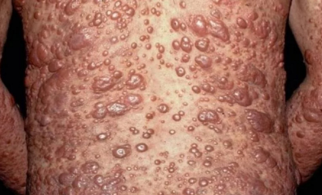 leprosy on the back leprosy on the back