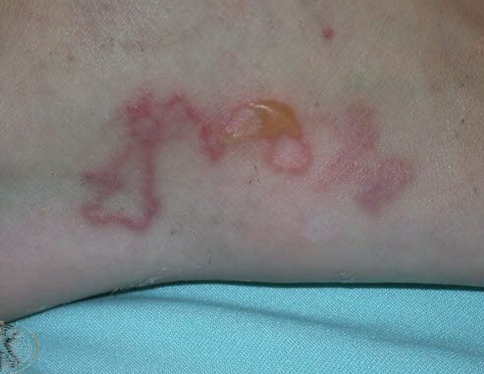 Hookworm
                disease (ankylostomiasis)