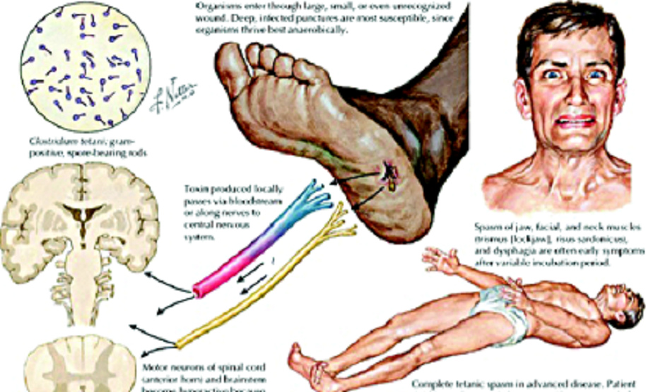 circulation with tetanus, scheme (English) circulation with tetanus, scheme (English)