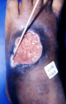 Carnivorous phageenic ulcer in Africa Carnivorous phageenic ulcer in Africa