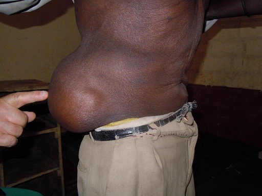 Inguinal hernia (abdominal hernia) with a man
from Sudan Inguinal hernia (abdominal hernia)
with a man from Sudan