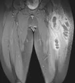 Muscle abscesses in the thigh, X-ray photo