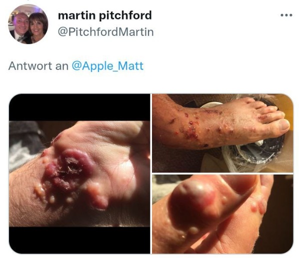 "Affenpocken" 28.8.2022: ist
eigentlich Herpes-Simplex-Virus "Affenpocken" 28.8.2022: ist
eigentlich Herpes-Simplex-Virus