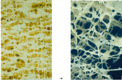 Osteoporose,
                                      Knochenver�nderung