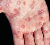 Syphilisgeschw�re an einer Hand�
