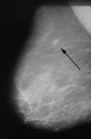 X-ray photo
                                with a breast cancer