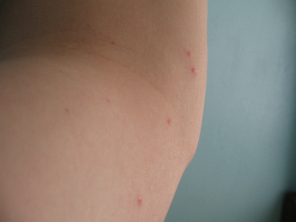 Fl�he, Frassbild 02 (2008) am linken Oberarm