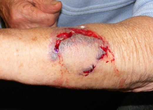 Herida grave en un
brazo por un Pitbull Herida grave en un brazo por un
Pitbull