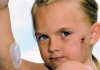 La ni�a Amber Churm de
                                    Thurnscoe en la provincia de South
                                    Yorks en Inglaterra, con heridas en
                                    su cara y en uno de su brazo por un
                                    Staffordshire Bull Terrier agresivo
                                    [70]