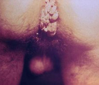 Condylomata-Warzen am Anus