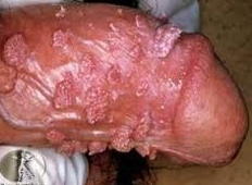 Condylomata-Warzen am Penis