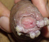 Condylomata warts on the foreskin