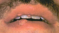Condylomata warts on the mouth