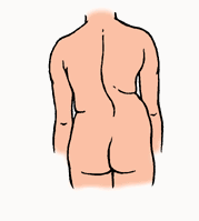 Skoliose
                          (R�ckgratsverkr�mmung) durch zu viel
                          einseitige Belastung bei dezentral gehaltenen
                          Musikinstrumenten.