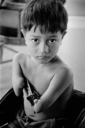 Gensch�den durch Agent Orange, fehlende Arme