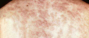 Schwarze Syphilis am Rücken Schwarze Syphilis
am Rücken