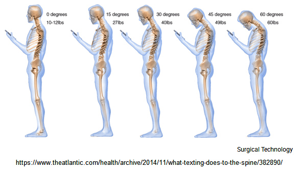 Der Handy-Buckel: Handysucht und iPhone-Sucht
                provoziert einen Buckel