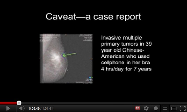 Krebs durch Handy an der Brust Krebs durch
Handy an der Brust