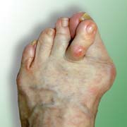 Fussverst�mmelung durch St�ckelschuhe:
                        Reiterzehe �ber Schiefzehe (Hallux Valgus) mit
                        Spreizfuss und H�hneraugen und wunden Stellen
                        (02)