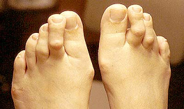 Krallenzehen bei einer betroffenen,
                          dummen Frau ("Tussi"), die zu lange
                          hohe St�ckelschuhe trug, wo sich die Zehen
                          immer zur�ckziehen mussten