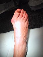 Krummer grosser Zeh (Hallux valgus),
                          provoziert durch dauerndes Tragen von spitz
                          zulaufenden St�ckelschuhen
