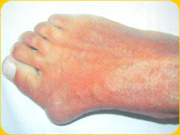 Diese Frau hat so lange High-Heels
                          getragen, bis dieser Spreizfuss mit Schiefzehe
                          (Hallux valgus) entstand